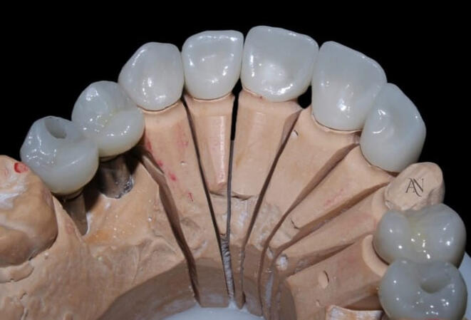 Porcelain veneers treatment at dental clinic in Chembur near D Mart.