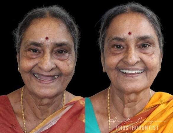 Full mouth rehabilitation by MDS Prosthodontist in Chembur Mumbai.