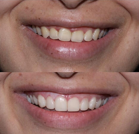 Smile designing treatment at PRYSM Dental Clinic Chembur