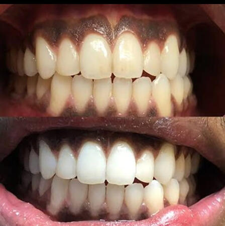 Cosmetic teeth whitening at dental clinic in Chembur